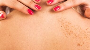 skin discoloration on back