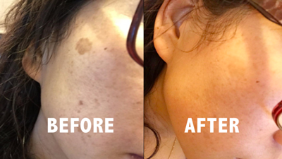 Amaira Natural Lightening Serum review with before and after photos