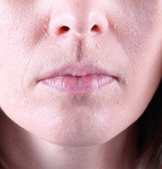womans face peeling after glycolic acid peel