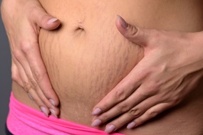 stretch marks on stomach after pregnancy