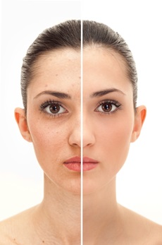 woman's face before and after microdermabrasion treatment