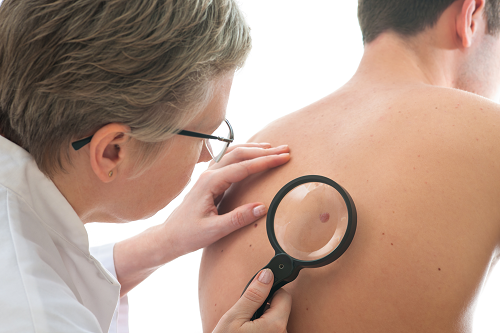 Doctor checking moles