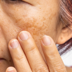 woman with melasma on her cheek
