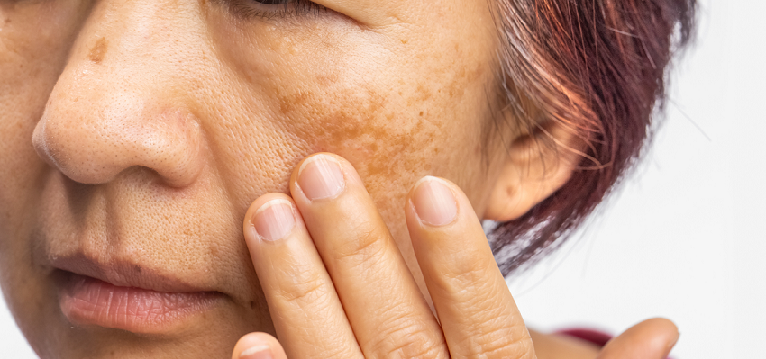 woman with melasma on her cheek